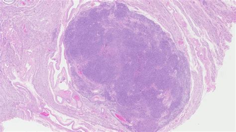 Leiomyoma of the uterus | MyPathologyReport.ca