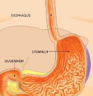 Understanding Esophageal Dilation - Reflux, Stomach Pain, Ulcers - Stephen Severance, M.D.