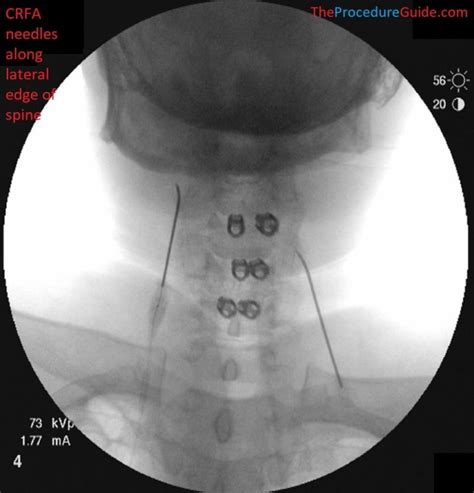 Fluoroscopic Guided Cervical Medial Branch Radiofrequency Ablation ...