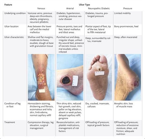 Diabetic Ulcers Vs Venous Ulcers Diabetic Ulcers Venous Ulcers | My XXX ...