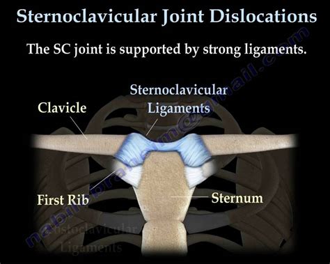 Sternoclavicular joint Dislocations - Everything You Need To Know - Dr. Nabil Ebraheim - YouTube