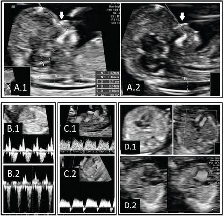 Prenatal Diagnosis of Down Syndrome | IntechOpen