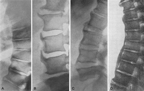 Forestier disease • LITFL • Medical Eponym Library