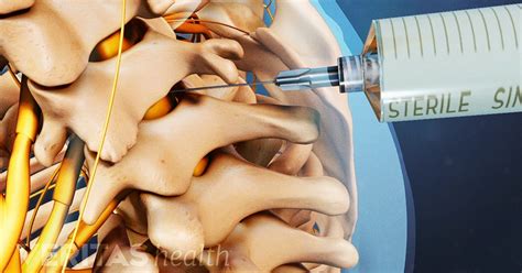 Cervical, Thoracic and Lumbar Interlaminar Epidural Injections