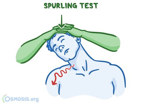 Spurling test | Osmosis