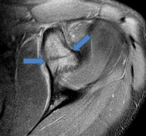 Today's Interesting Case: Isolated Coracoid Fracture - Radsource