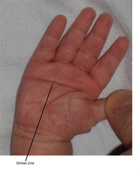 palmistry: Know your Future: Simian lines on a palm