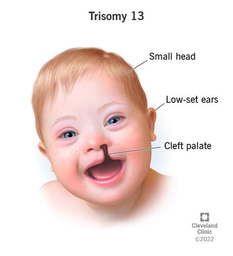 Trisomy 13 Patau Syndrome Pictures | Hot Sex Picture