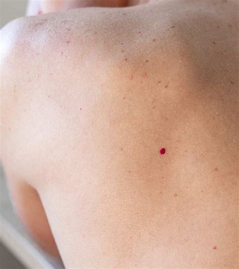 Cherry Angioma: Causes, Treatments, And Risk Factors