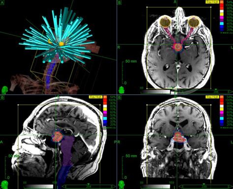 Brain Stereotactic Radiosurgery with CyberKnife | Accuray