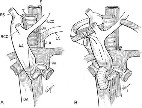 Reoperation after Vascular Ring Repair - Seminars in Thoracic & Cardiovascular Surgery ...