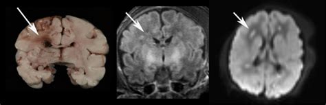 Matching images of ischemic white matter injury in the periventricular... | Download Scientific ...