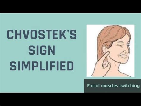 Chvostek Sign- Hypocalcemia - YouTube