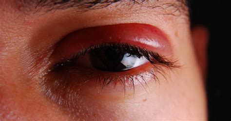Shingles in the eye: Symptoms, treatment, and prevention