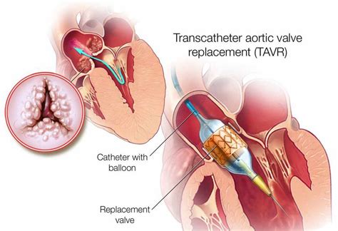 Surgical Repair Of A Heart Valve Medical Term - Coisas da Naty