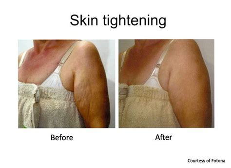 Body Laser Skin Tightening | Prasad Cosmetic Surgery NYC