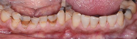 Chipped Teeth Dental Fillings in Eureka, MO | Before & After