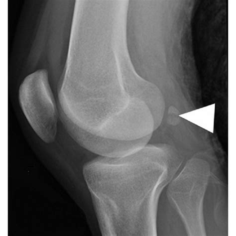 A sagittal T2-weighted fat-suppressed MRI demonstrated diffuse bone ...