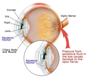 What Are the Signs of Open Angle Glaucoma? - Keck Medicine of USC