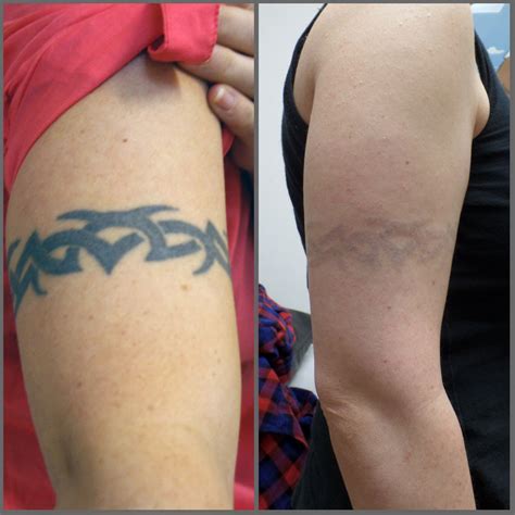 Álbumes 97+ Foto Tattoo Laser Removal Before And After Mirada Tensa