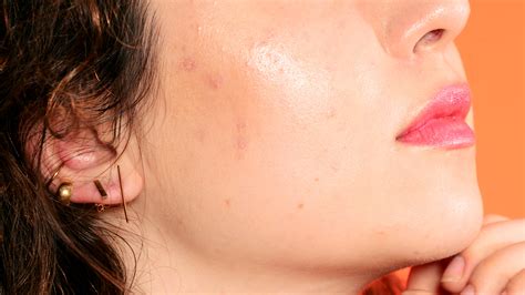 Hormonal Acne: What It Is And Why It Happens Columbia Skin Clinic | atelier-yuwa.ciao.jp