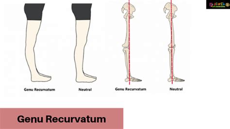 Genu Recurvatum | Type and Causes of Genu Recurvatum