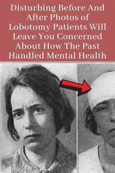 Disturbing Before And After Photos of Lobotomy Patients Will Leave You Concerned About How The ...