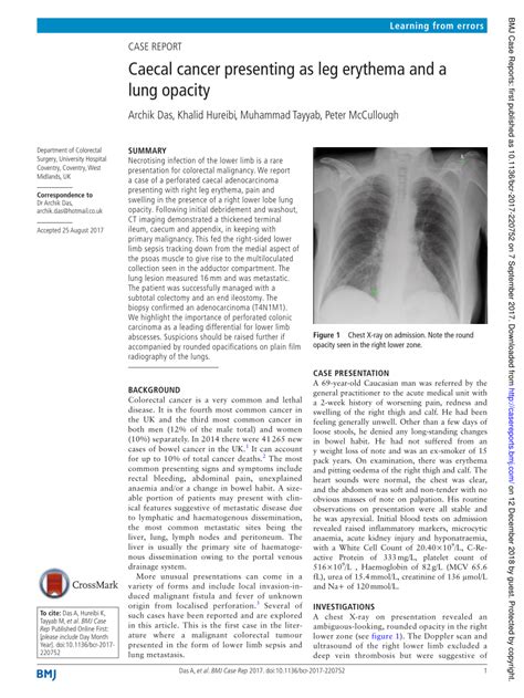 (PDF) Caecal cancer presenting as leg erythema and a lung opacity