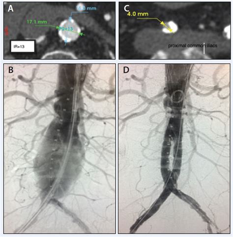 The Ovation Abdominal Stent Graft Creates a Patient-Specific EVAR Seal in a Variety of Anatomies ...