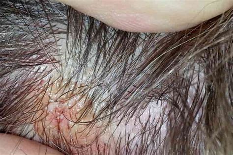 Scabs and Sores on Scalp: 17 Causes, Pictures and Treatment