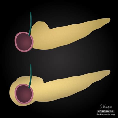 Annular pancreas: diagrams | Radiology Case | Radiopaedia.org Medical Illustrations, Radiology ...