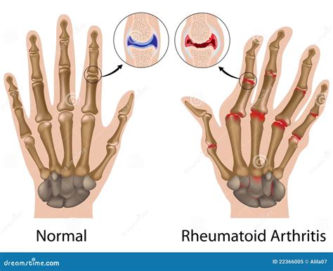 Rheumatoid Arthritis of Hand Stock Vector - Illustration of capsule ...