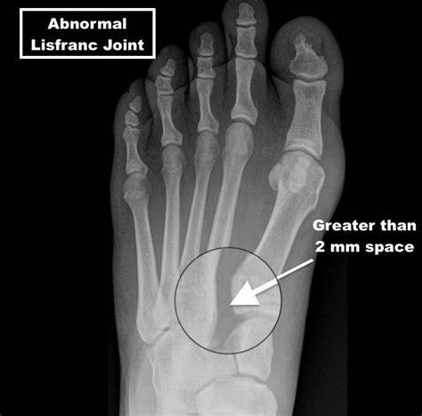 Lisfranc Injury - A Matter of a Few Millimeters