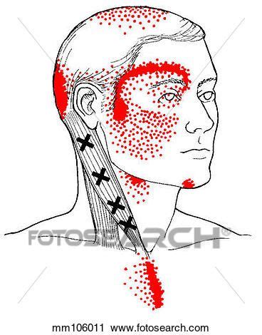 Sternocleidomastoid m., trigger points View Large Illustration Massage ...