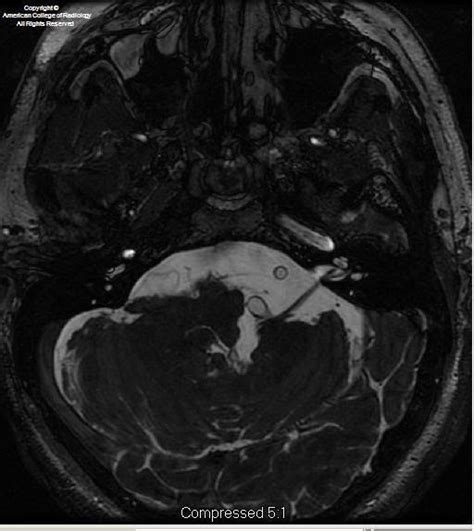 Neuroradiology On the Net: Basilar dolichoectasia determining a vascular loop compression syndrome