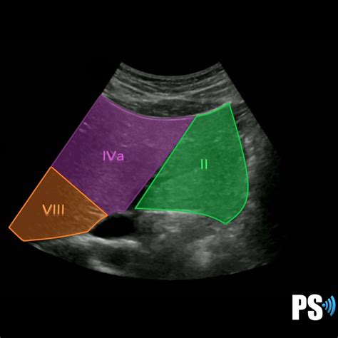 Couinaud’s Liver Segments – Sonographic Tendencies