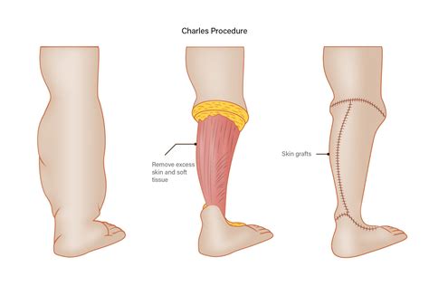 Lymphedema Surgery - Treatment - Siteman Cancer Center