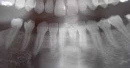 Peripheral Ossifying Fibroma Definition, Symptoms, Causes, Treatment