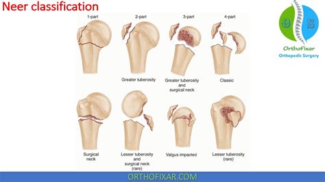 Proximal Humeral Fracture Classification