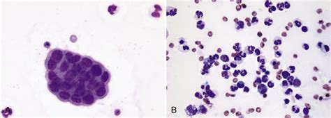 leukocytes in urine sediment