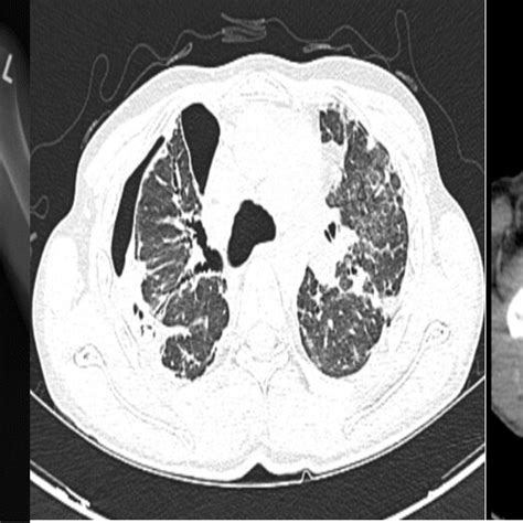 Deepened suprasternal notch in patient #1. | Download Scientific Diagram