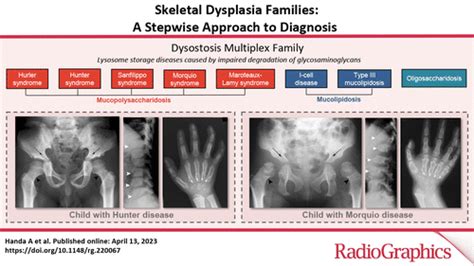 Spondyloepiphyseal Dysplasia Dwarfism