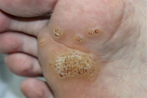 Verrucae and Warts | Lindsey Ebbs Podiatry