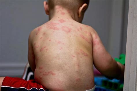 Exanthema subitum - (roseola infantum, sixth disease, thre… | Flickr