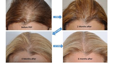 Hair Loss Treatments (Surgical) For Women - Dr. David Rosenberg