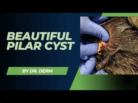 Dr. Derm - Pilar Cyst Removal : r/Popping_Curated