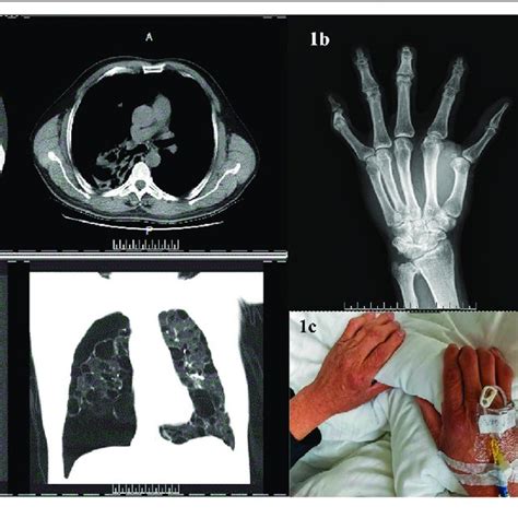 | The genealogical tree of Birt-Hogg-Dubé syndrome and congenital... | Download Scientific Diagram