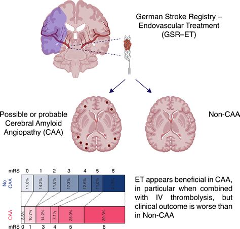 Endovascular Treatment for Acute Stroke in Cerebral Amyloid Angiopathy ...