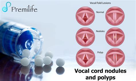 Vocal Cord Nodules and Polyps | Premilife - Homeopathic Remedies