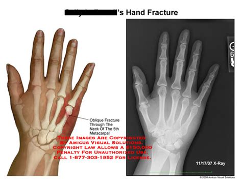 AMICUS Illustration of amicus,injury,hand,wrist,fracture,metacarpal,oblique,radiology,x-ray